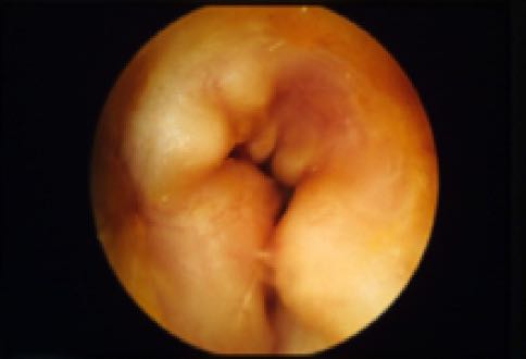 Exostosen