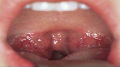 Tonsillotomie