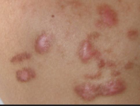 keloid