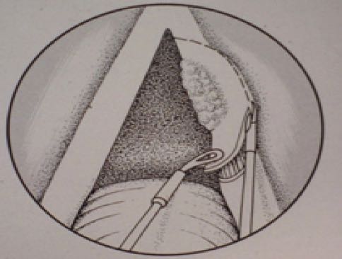 larynxteil