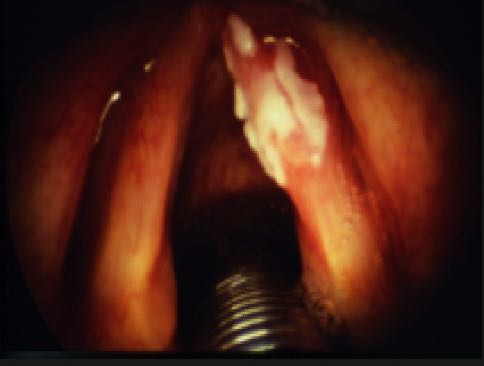 larynxteilresektion
